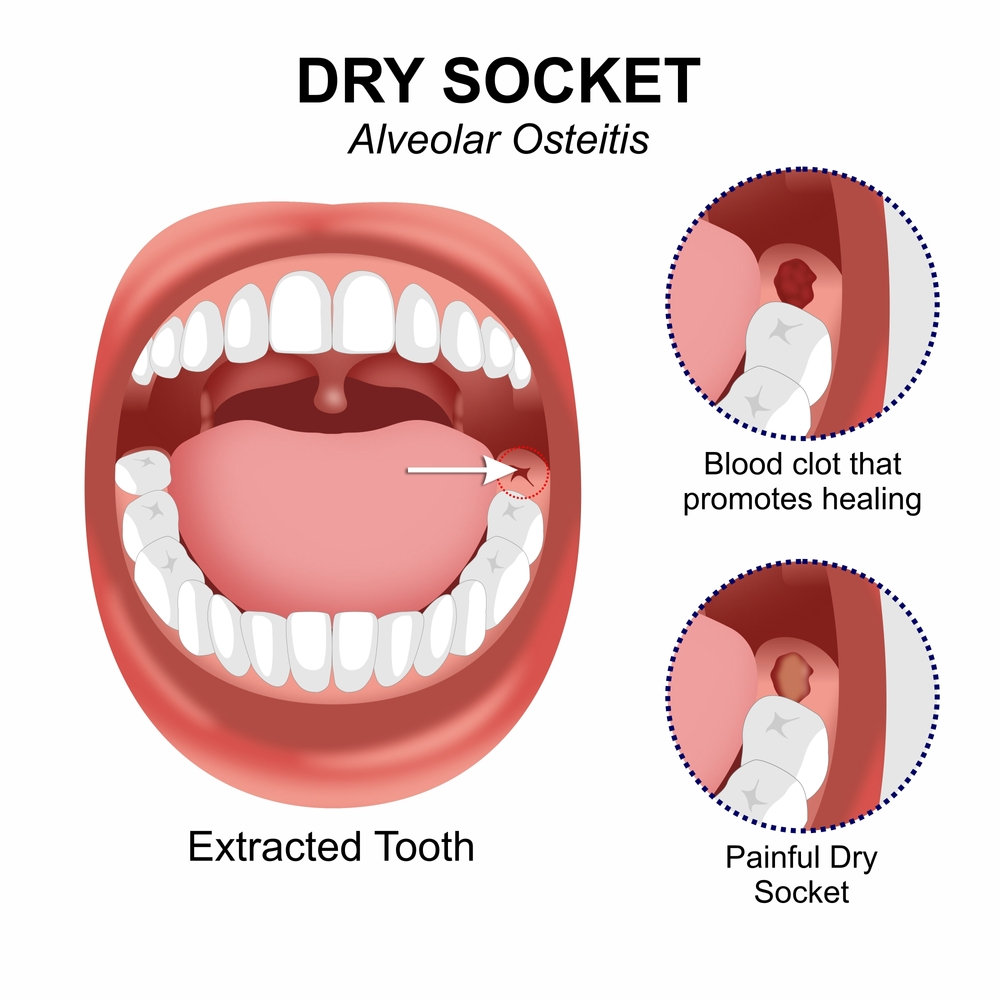 blood clot vs dry socket after tooth extraction