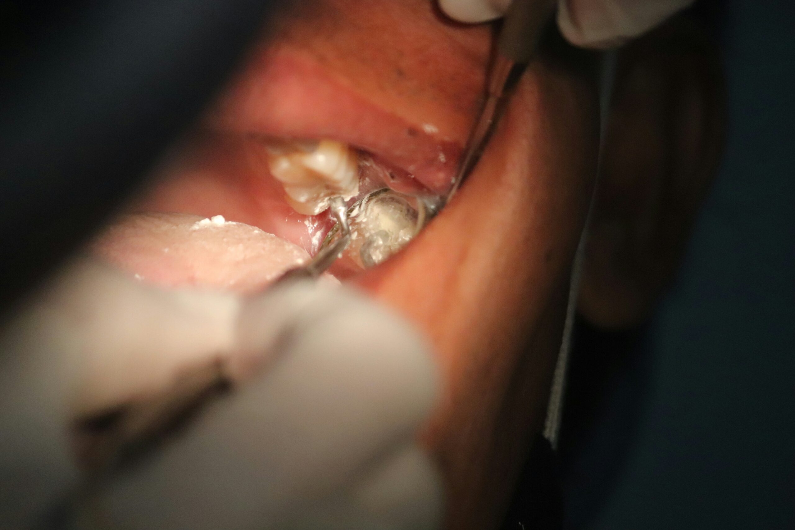 care for your mouth after tooth extraction