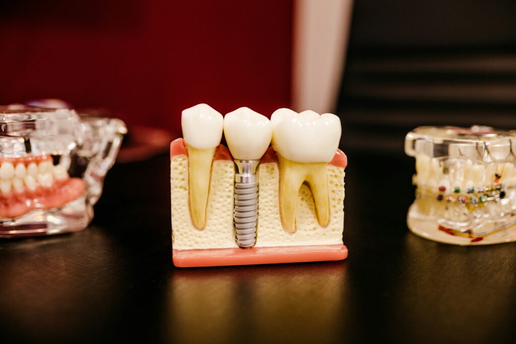 dental implant in Lagos