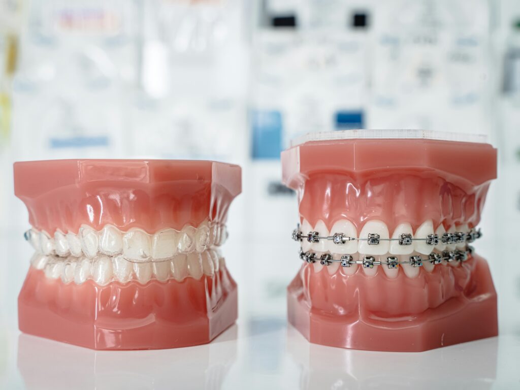 braces in Lagos