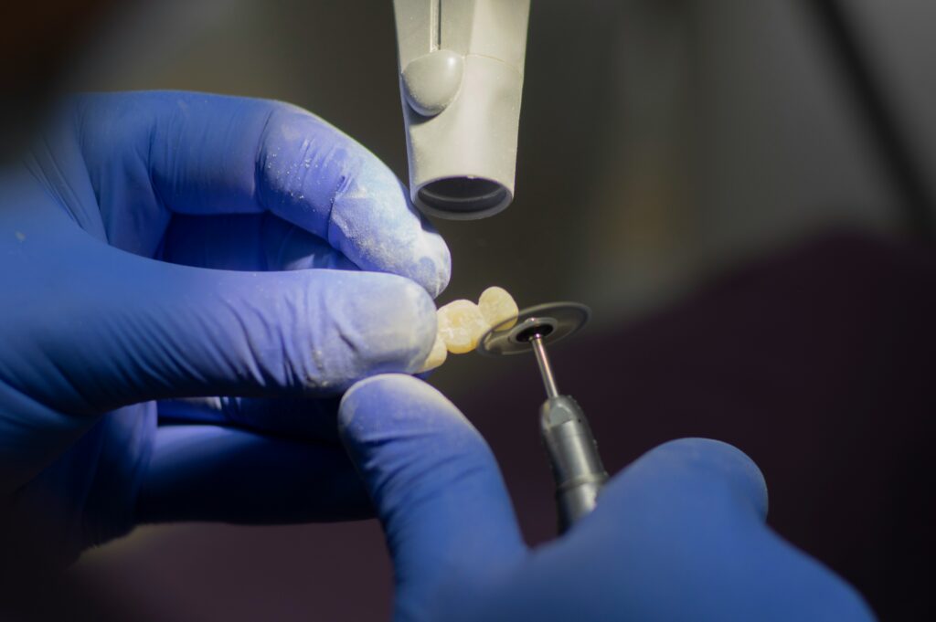 veneers in Lagos at Lumis Dental Clinic Lekki Phase 1