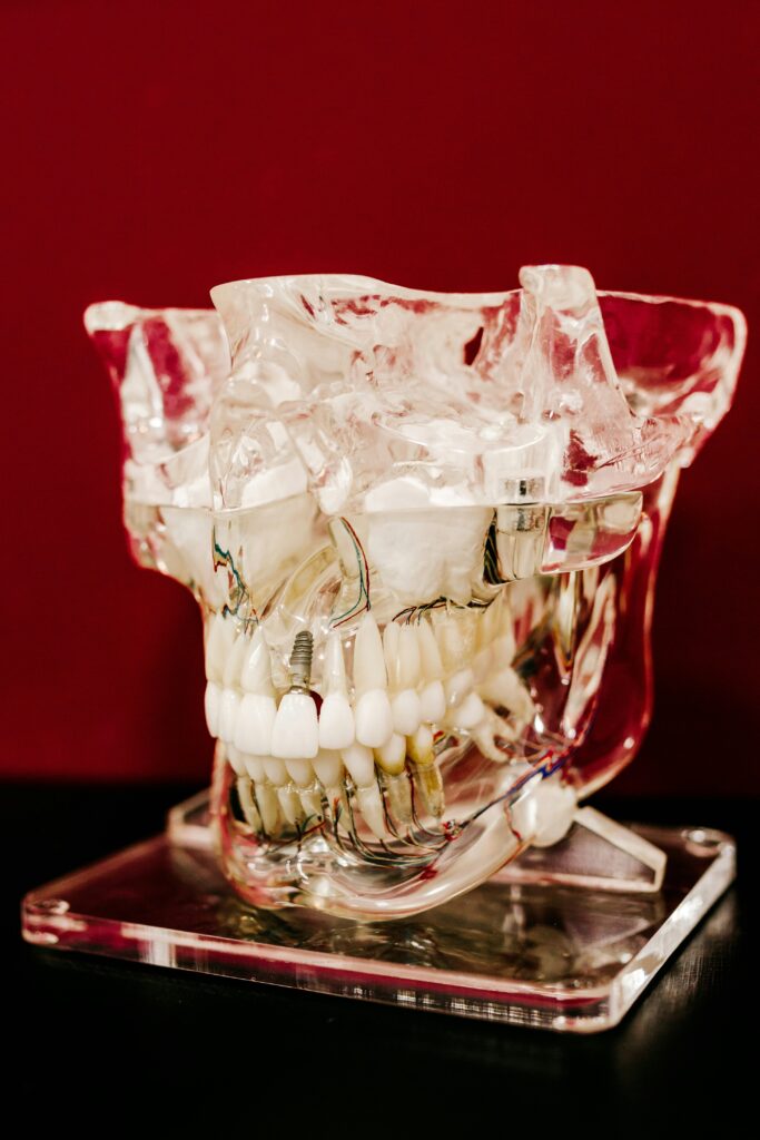 Transparent dental jaw model showing a titanium implant post inserted into the jawbone, used to explain dental implant longevity in Lagos